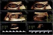 Evaluation and Predictive Value of Placental Thickness in Fetal Biometric Assessment and Doppler Indices of the Uterine and Umbilical Arteries Original Article